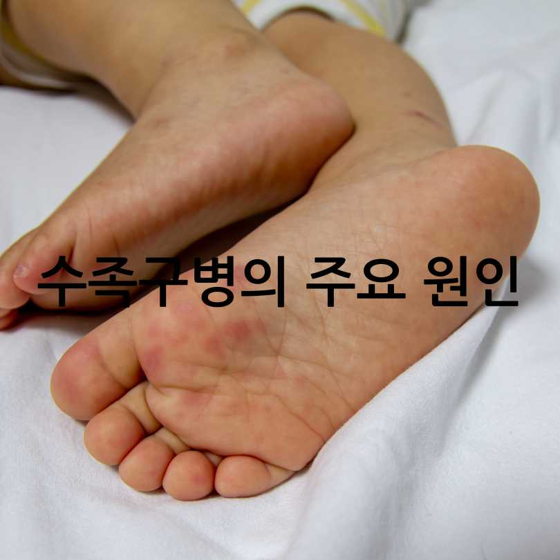 성인수족구 감염, 증상,원인, 경험담까지
