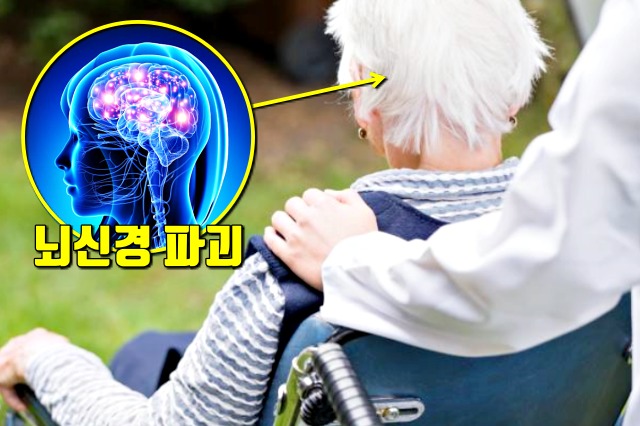 알츠하이머 치매, 잇몸병, 치주질환, 치주염, 풍치, 건강, 팁줌 매일꿀정보