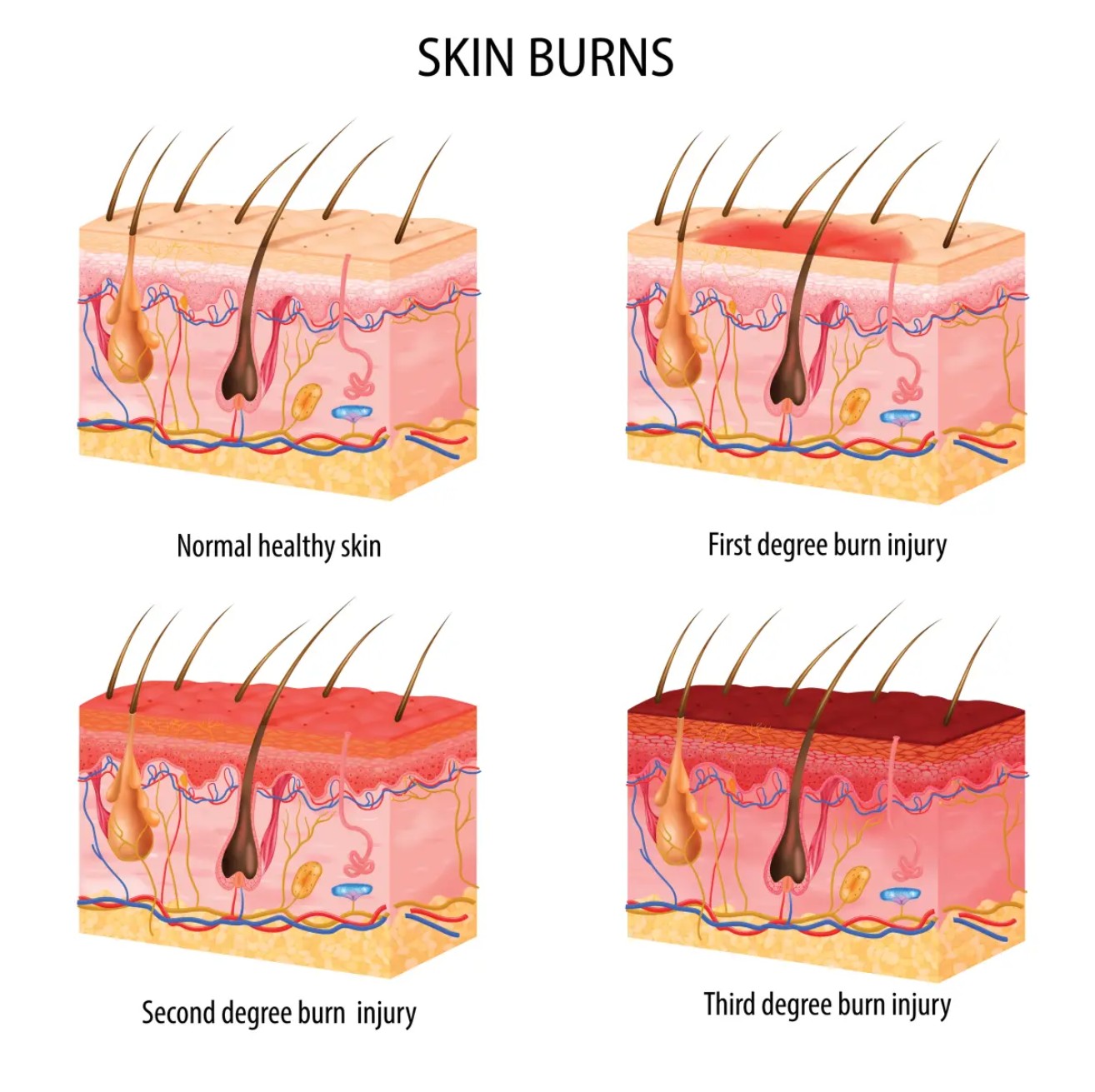 가정에서 화상 정도별 응급 대처법 (1도~3도)