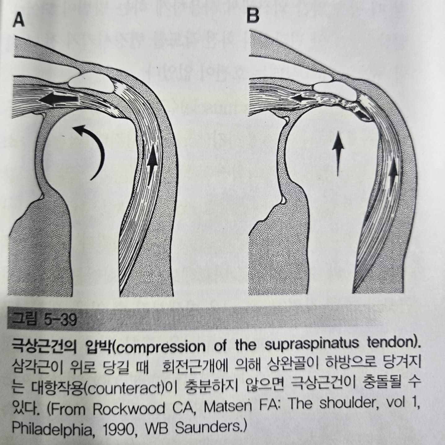 상완골의 운동손상 증후군 - 상완골 상방활주 증후군