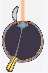 라식수술 나이제한