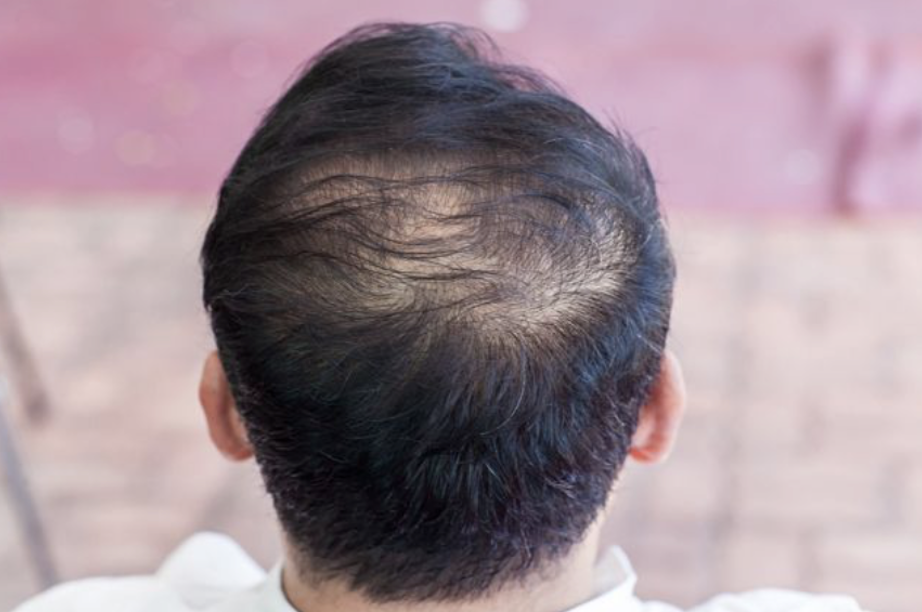 탈모에 좋은 음식 추천 모발을 위한 식단