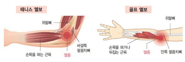 테니스엘보