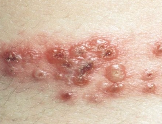 대상포진-초기증상-피부