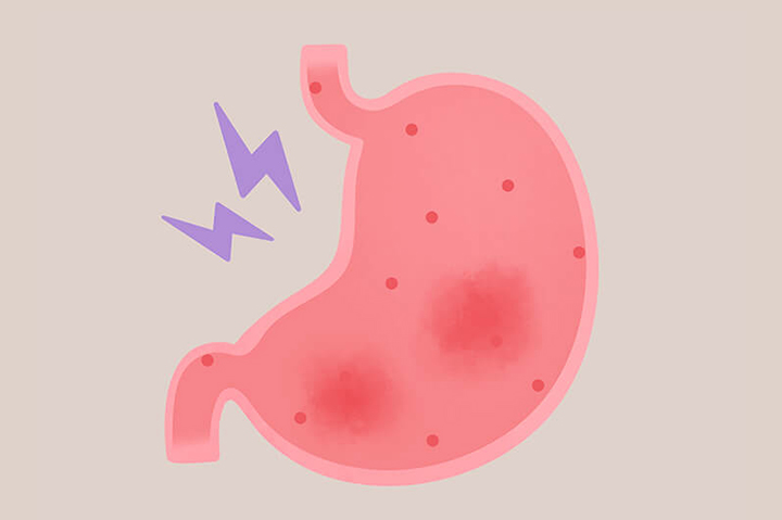 염증이-발생한-위장