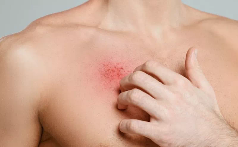 수포없는 대상포진