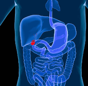 담낭염의 증상, 담낭 용종