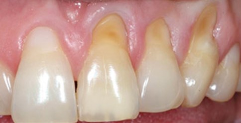 치경부마모증-비용