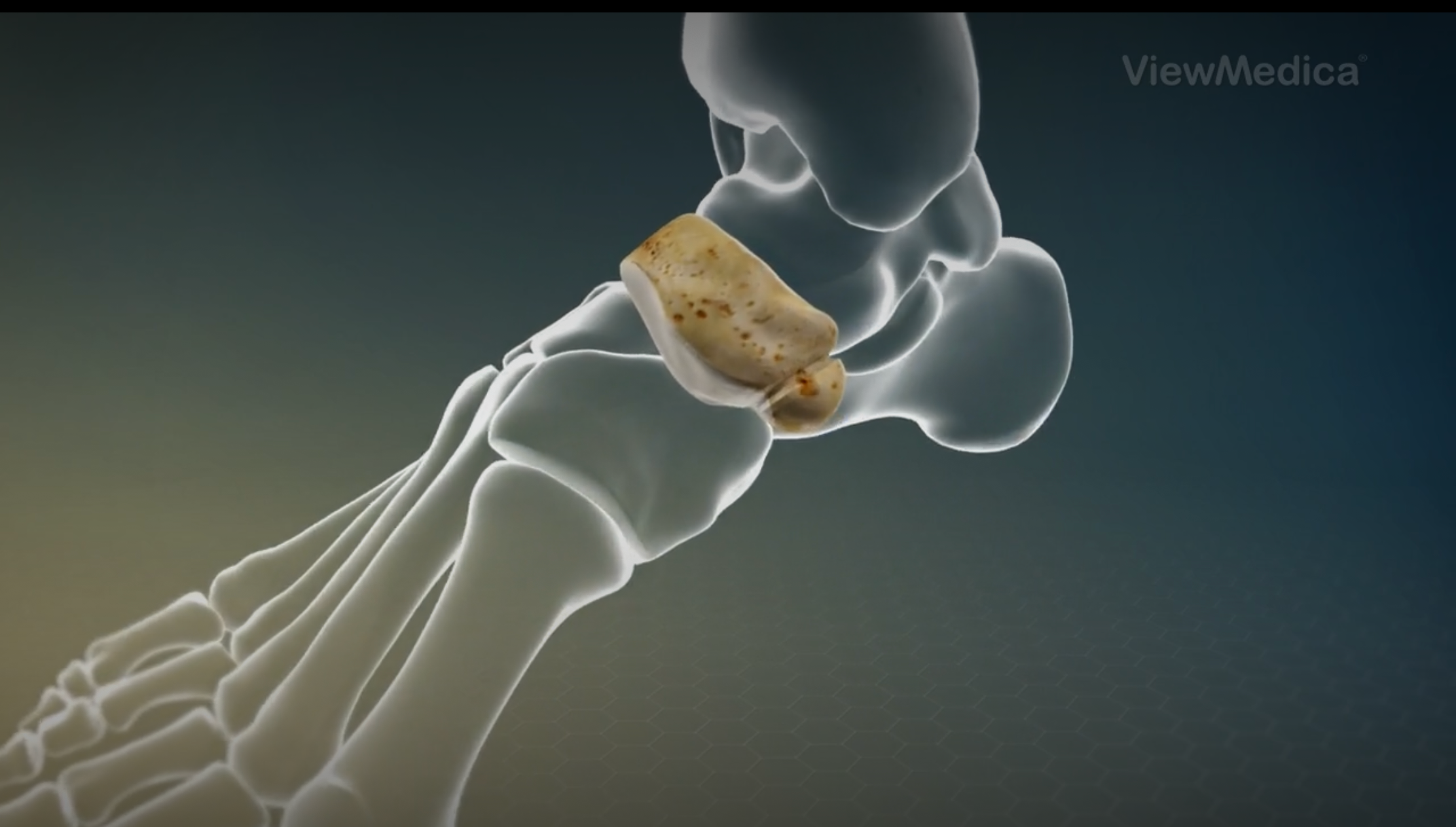 부주상골-Accessorynavicular