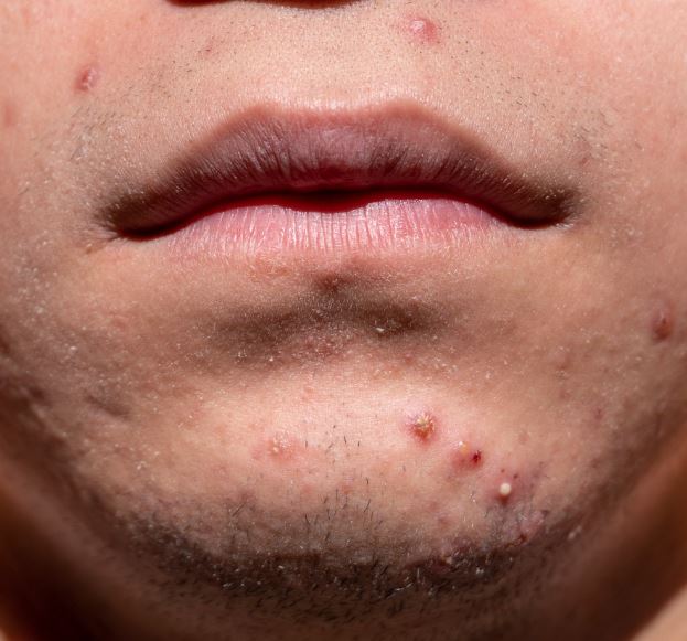 여드름 빨리 없애는 법 원인 증상