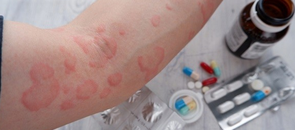 항히스타민 연고2