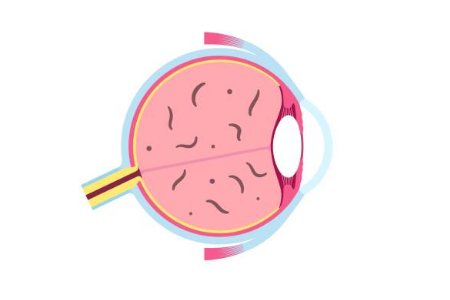비문증 치료방법, 자연치유, 원인 총정리 (2024ver)
