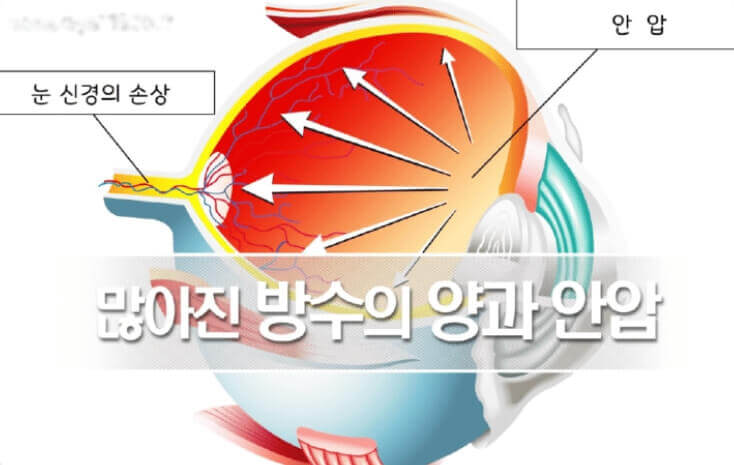 녹내장 안압