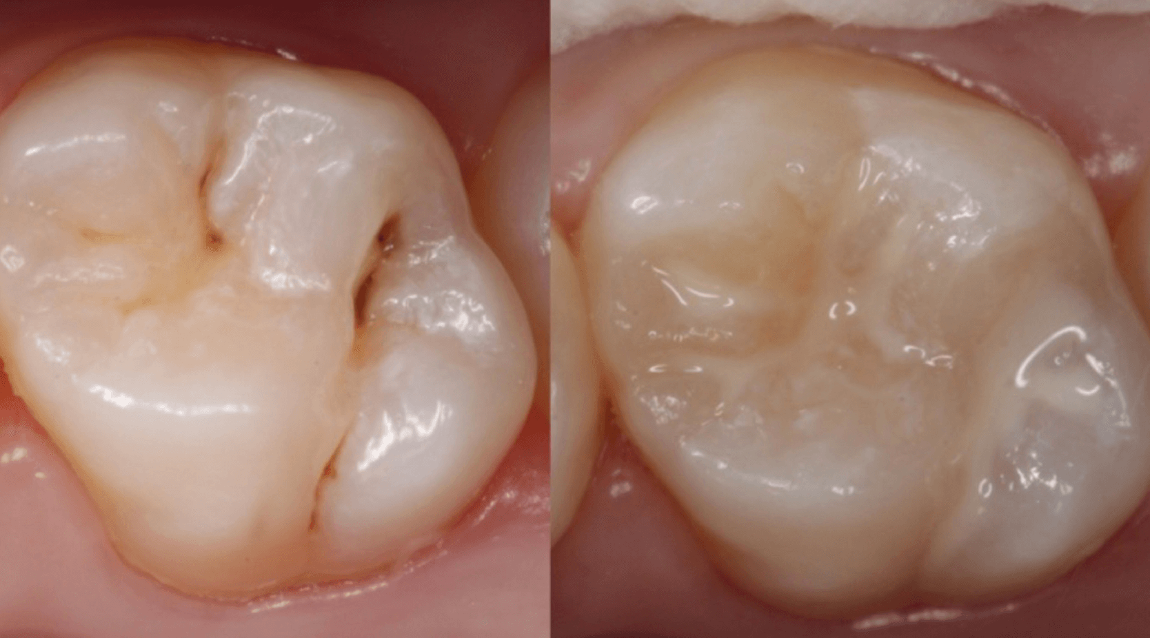 레진 치료 전후