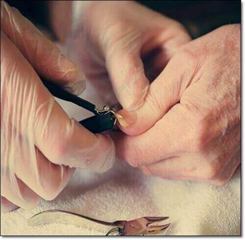 손톱 조갑박리증