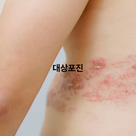 대상포진 신경통 증상과 완화법