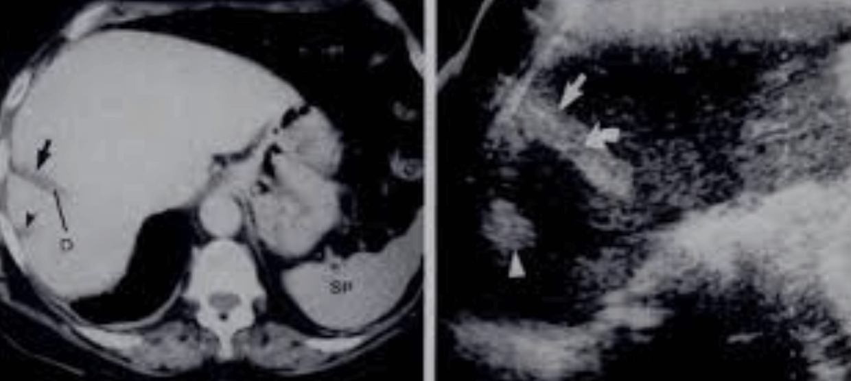 accessory hepatic fissure