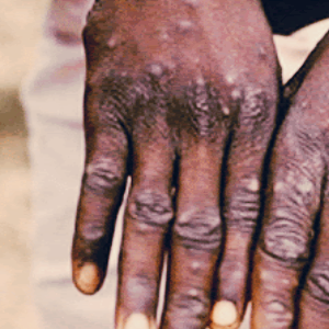 원숭이두창 엠폭스 관련주 TOP10