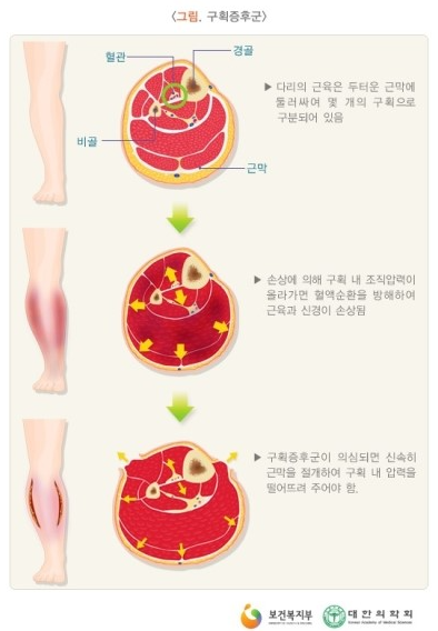 구획증후군 이미지