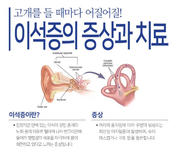 이석증 증상과 자가치료법