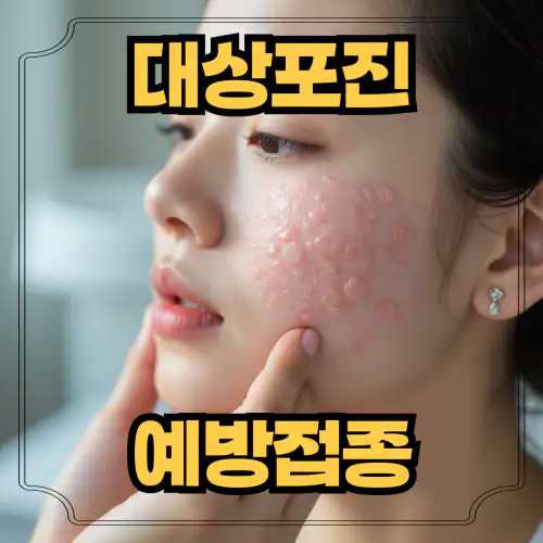 대상포진
