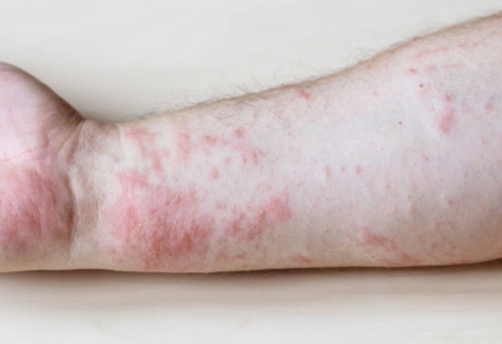 콜린성 두드러기