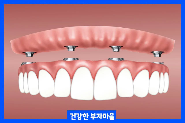 전체 임플란트 장점