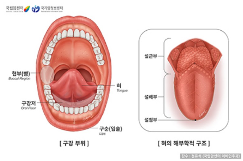 설암 투병 정미애