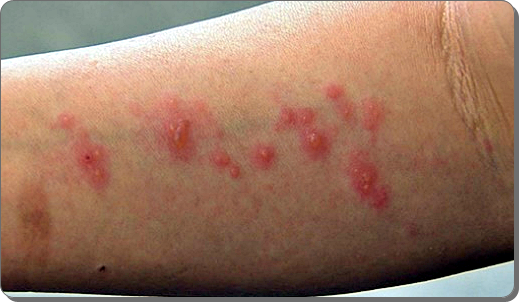 대상포진 초기증상 21