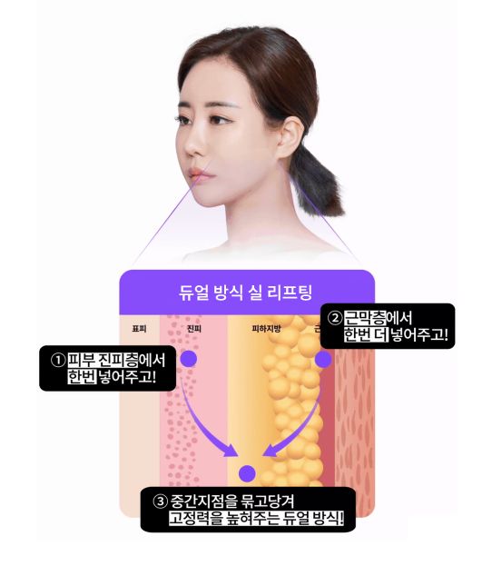 압구정실리프팅, 처진얼굴리프팅