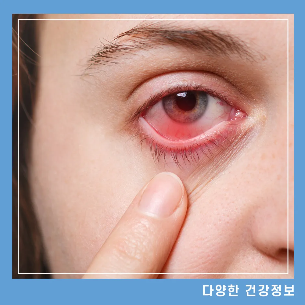 눈 실핏줄 터지는 이유 치료 방법