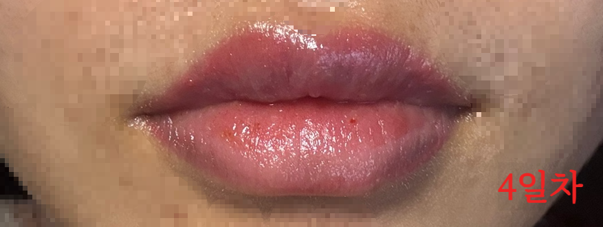 립타투 4일차 &ndash; 븟기는 가라 앉았으나, 건조함이 느껴지는 입술 상태