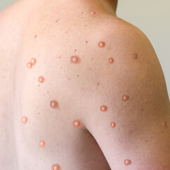 [ 엠폭스 증상 ] 치사율 감염경로 잠복기 국내발생 현황 및 원숭이 두창 백신