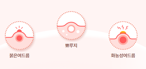 애크논크림-효과