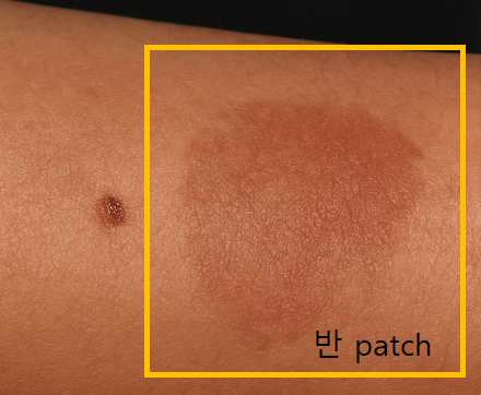 patch 반. 몽고반. 백반증