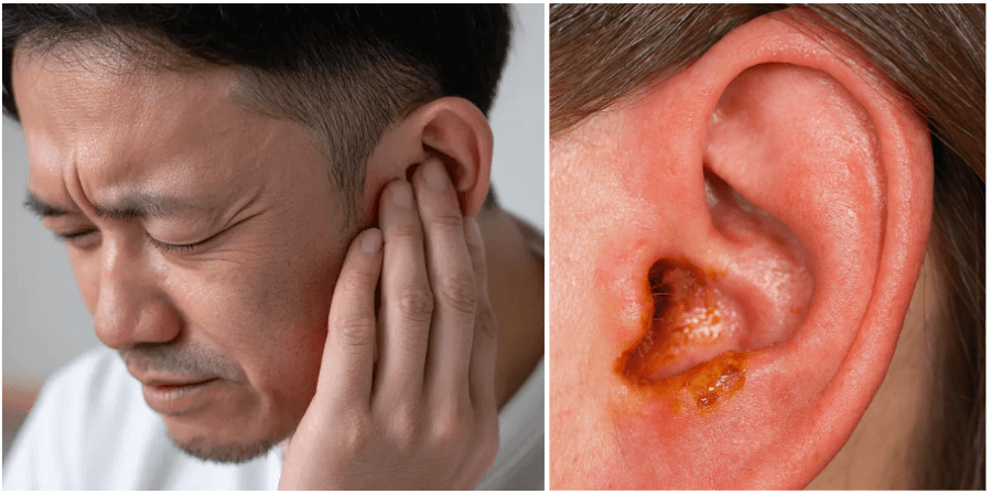 외이도염