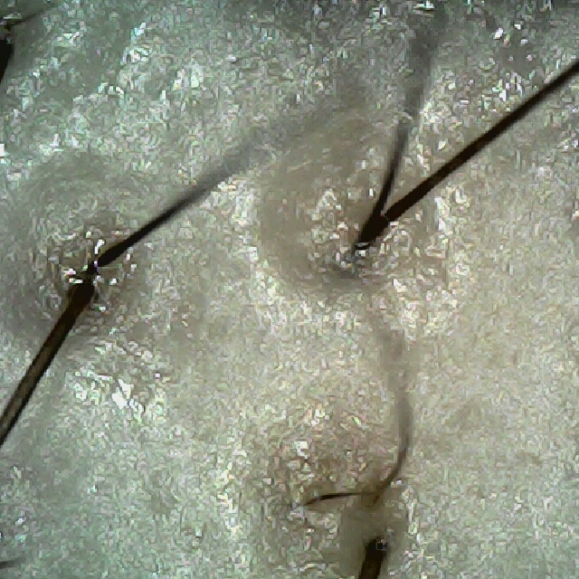 탈모 극복 프로젝트 - 정수리와 이마 사이 두피 모습이다.