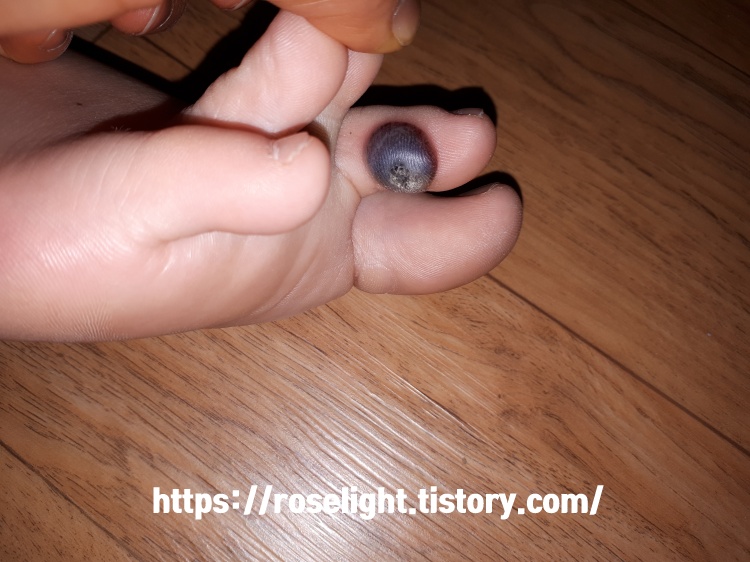 발가락사마귀-냉동치료후