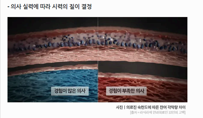 의사 실력에 따른 스마일 라식 사진