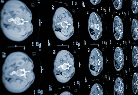 뇌경색의 원인과 증상, 진단, 치료와 예방 방법.