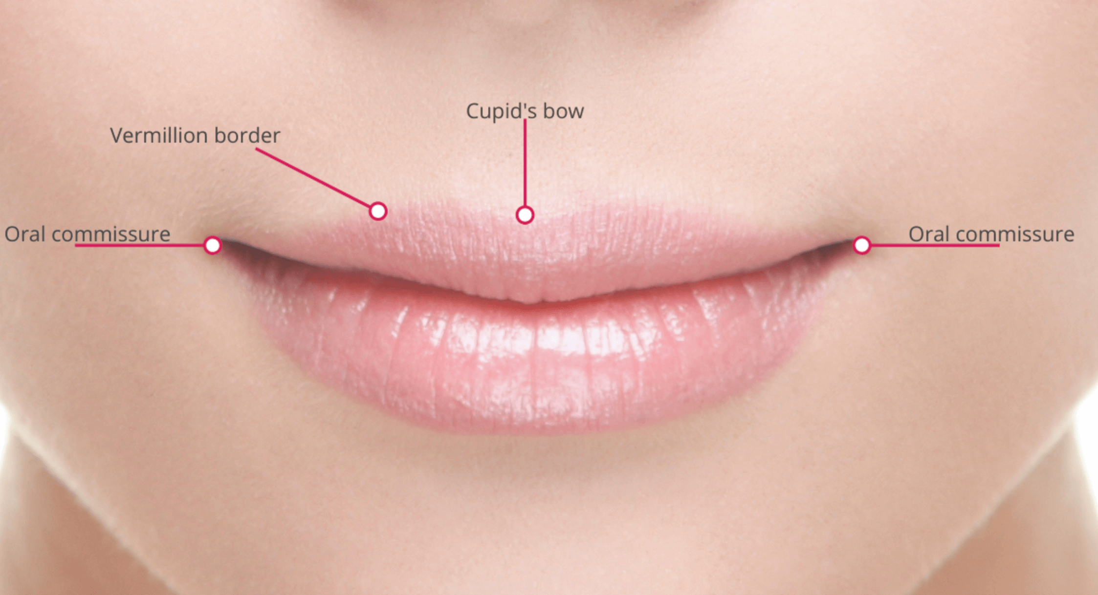 입꼬리 보톡스 효과