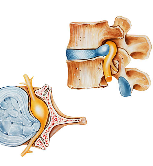 허리디스크 원인