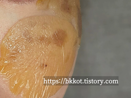 리팟레이저 후기