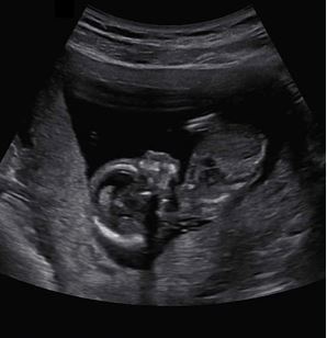 황지선 훈 임신 초음파