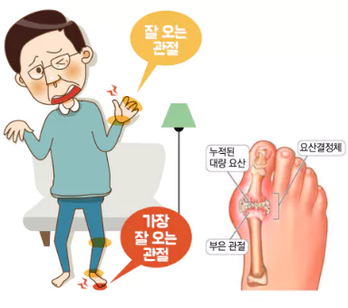 통풍-초기증상-및-치료