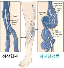 하지정맥류 