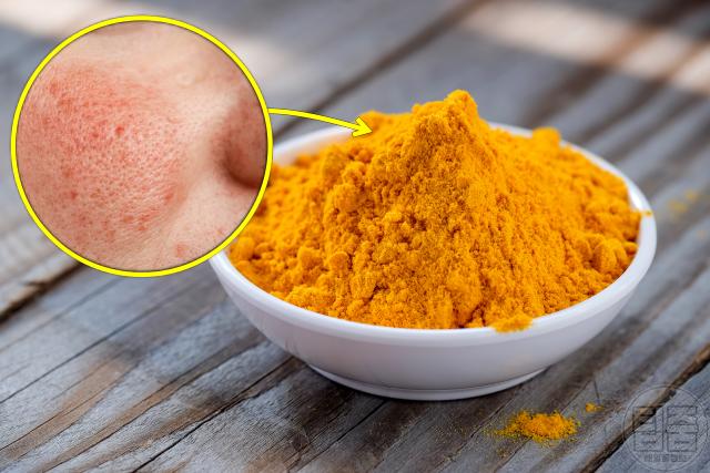 코 옆 볼 빨개짐 주사비 좋은 음식 강황가루