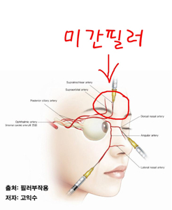 미간 주름 필러
