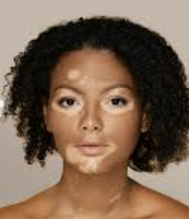 백반증 초기증상 21