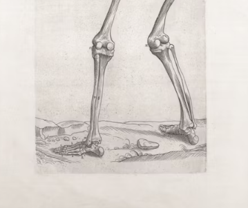 통풍 치료법 진단 기준 합병증